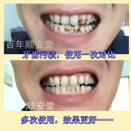 洗牙液白牙素牙齿美白水速效去黄牙烟牙茶渍牙垢牙菌斑洁牙粉牙贴
